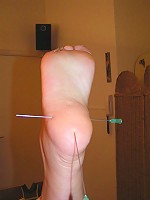 Needles in Feet
